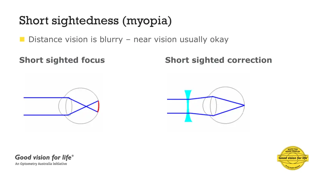 short sightedness myopia