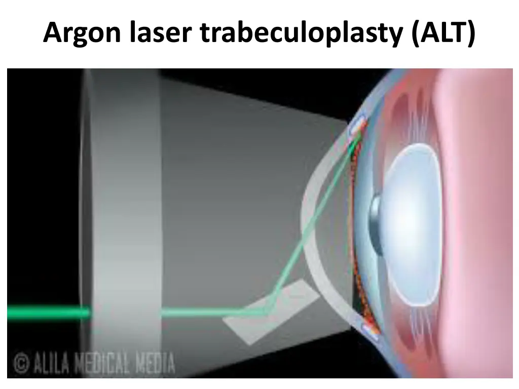 argon laser trabeculoplasty alt