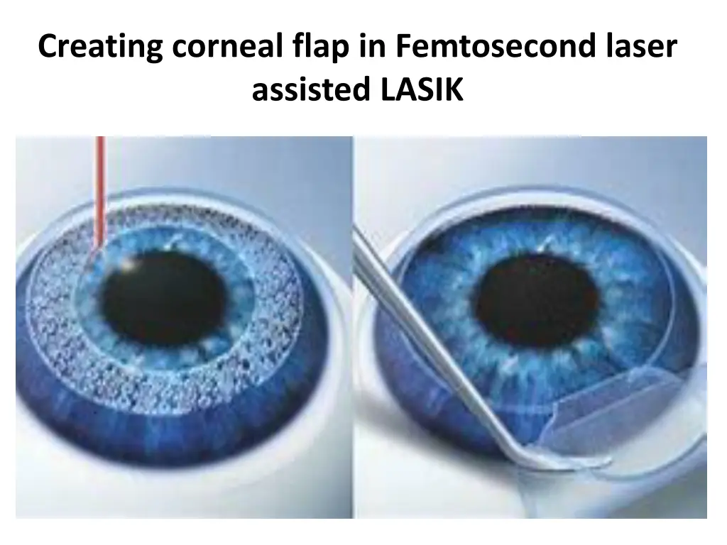 creating corneal flap in femtosecond laser