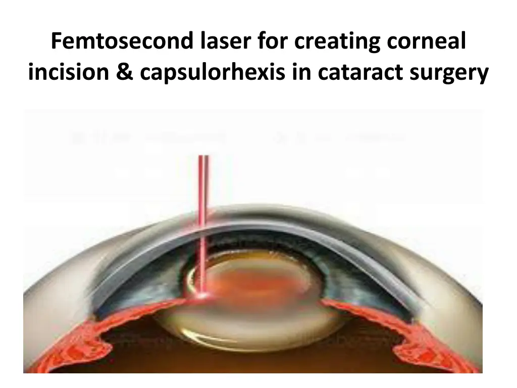 femtosecond laser for creating corneal incision