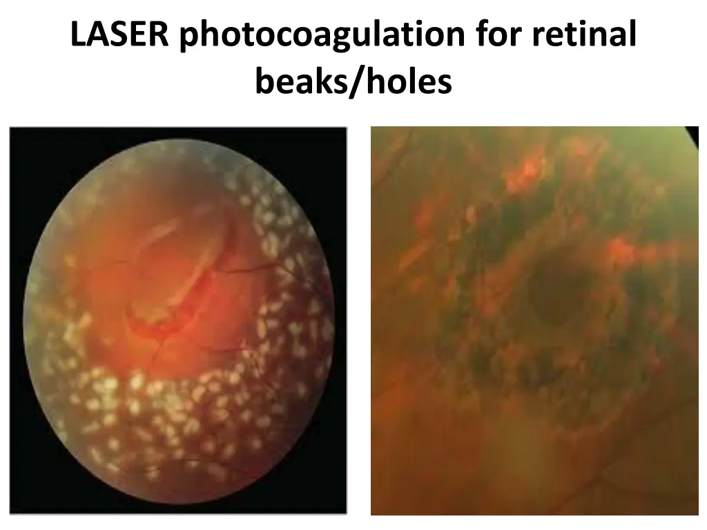 laser photocoagulation for retinal beaks holes