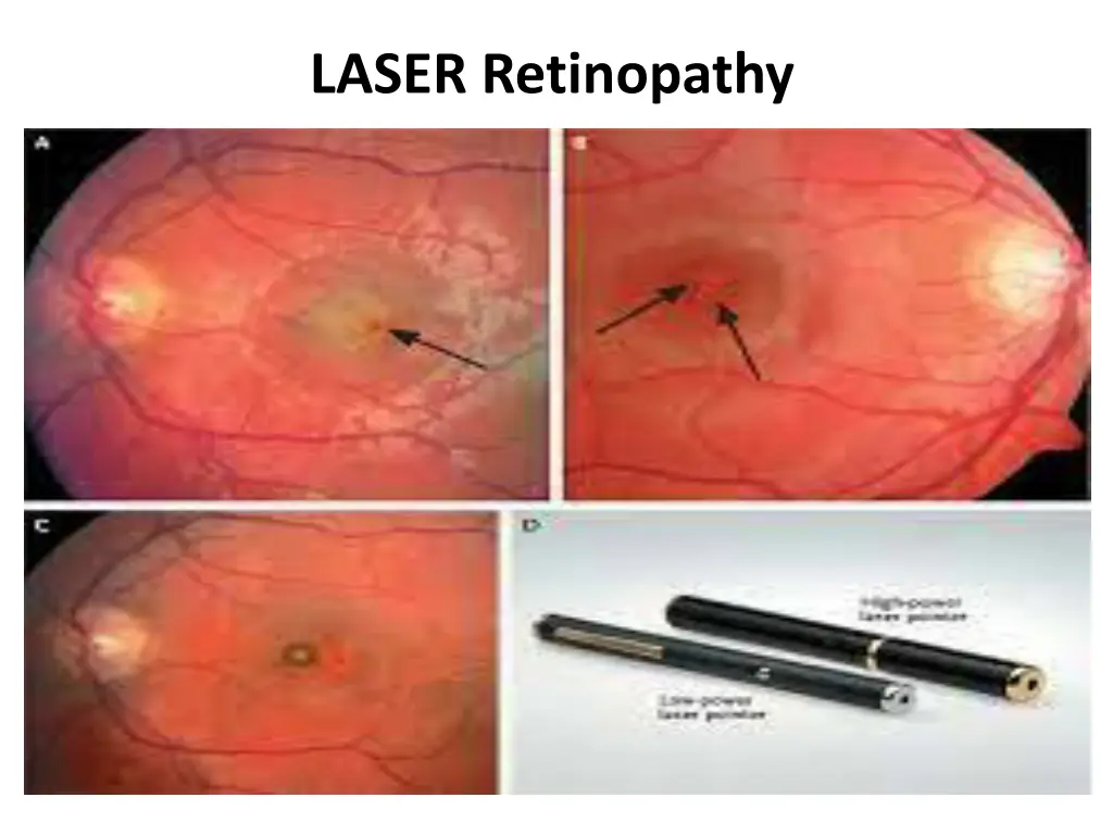 laser retinopathy 1