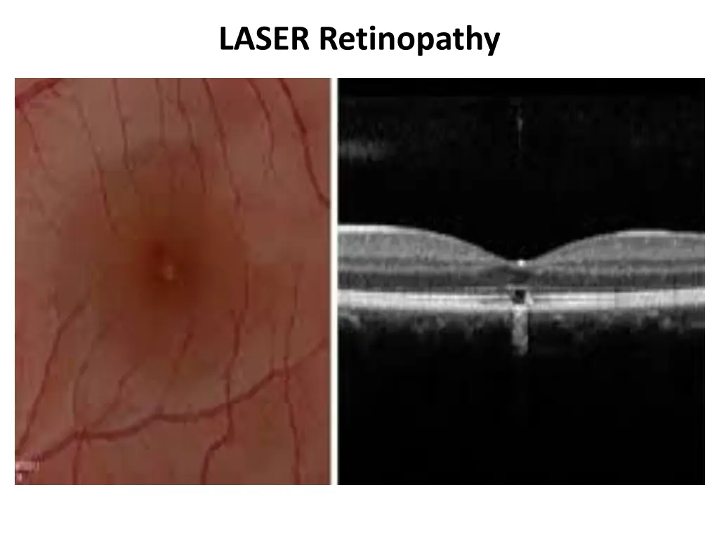 laser retinopathy 2