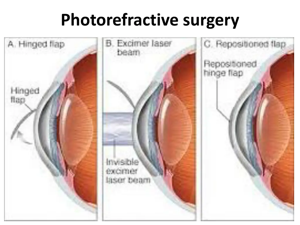 photorefractive surgery