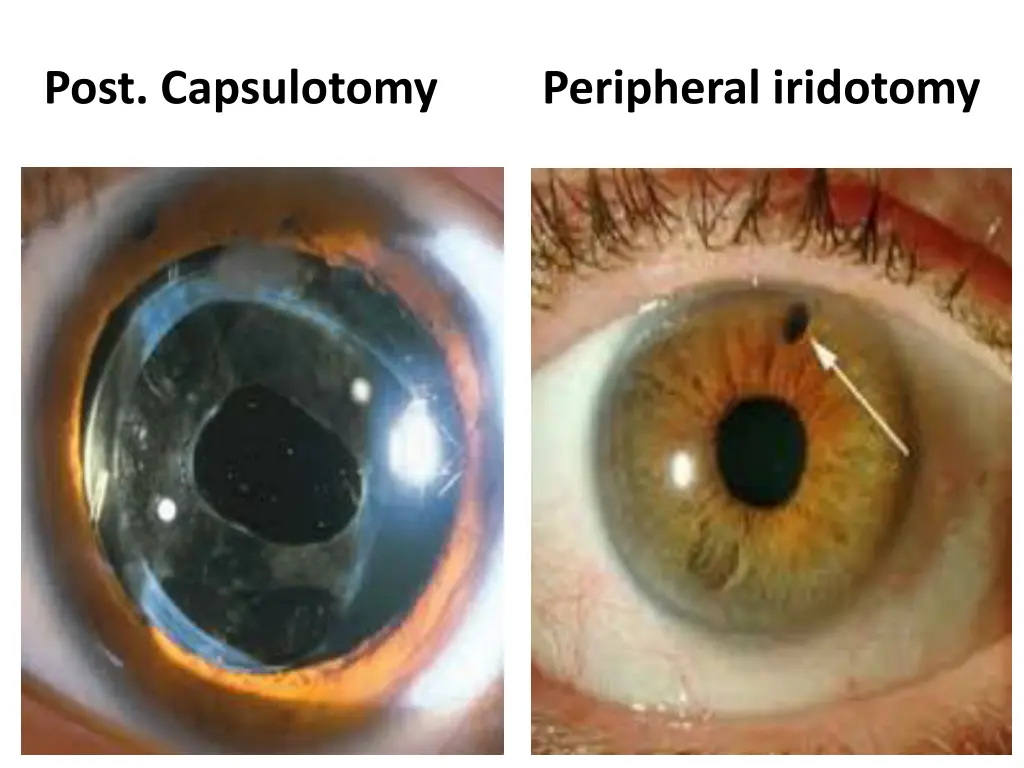 post capsulotomy