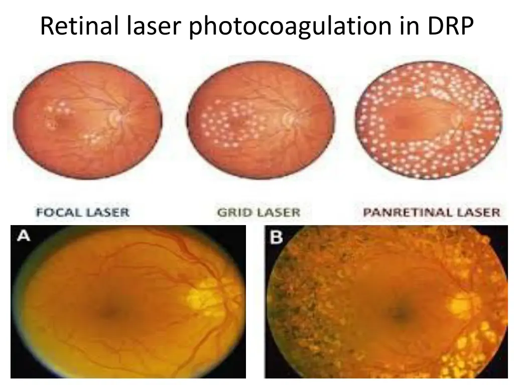 retinal laser photocoagulation in drp