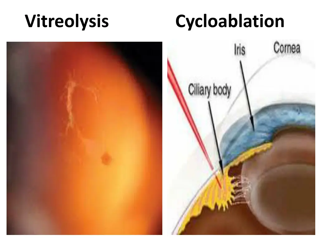 vitreolysis