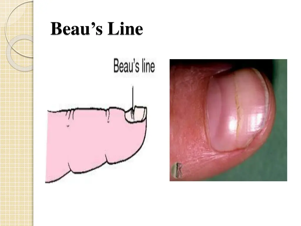 beau s line