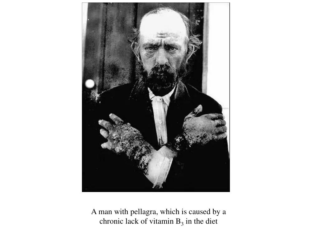 file pellagra nih jpg