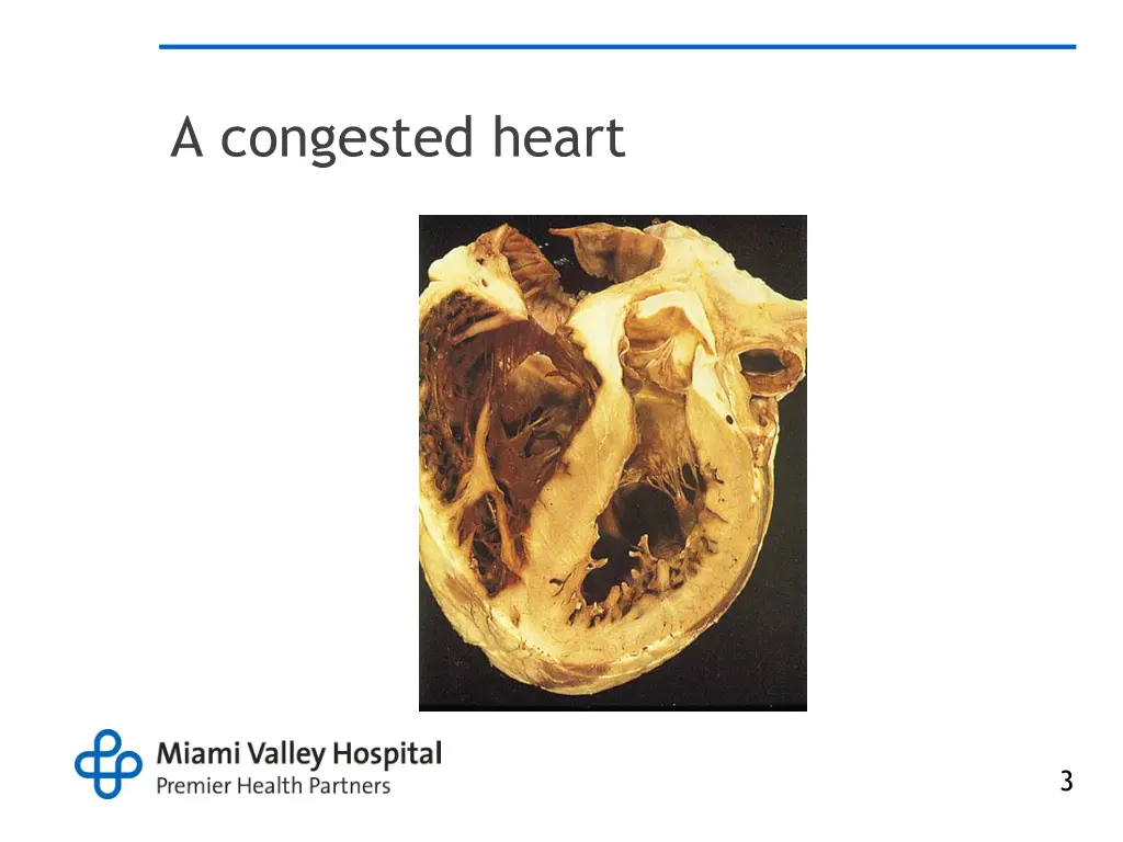 a congested heart