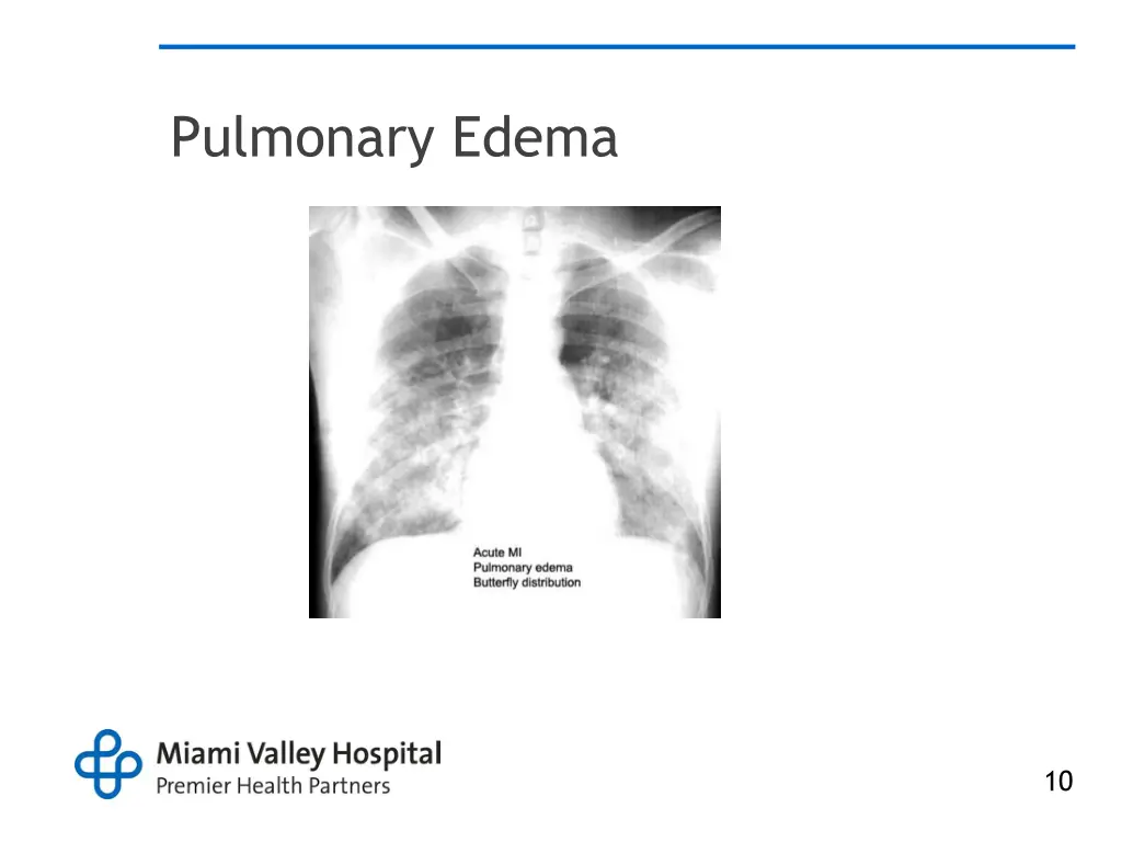 pulmonary edema