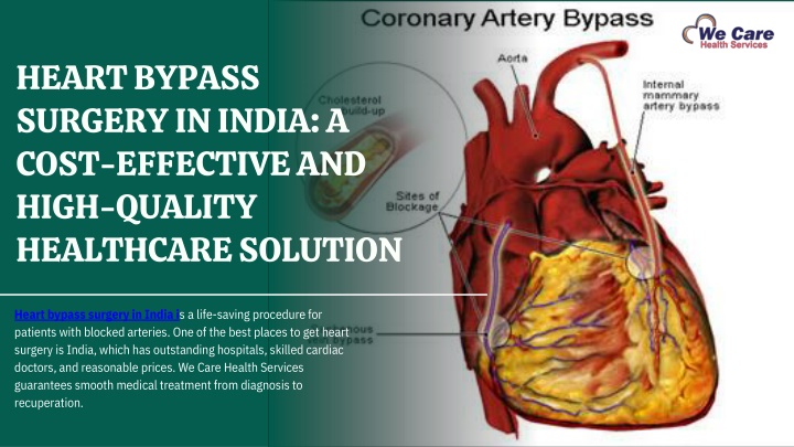 heart bypass surgery in india a cost effective