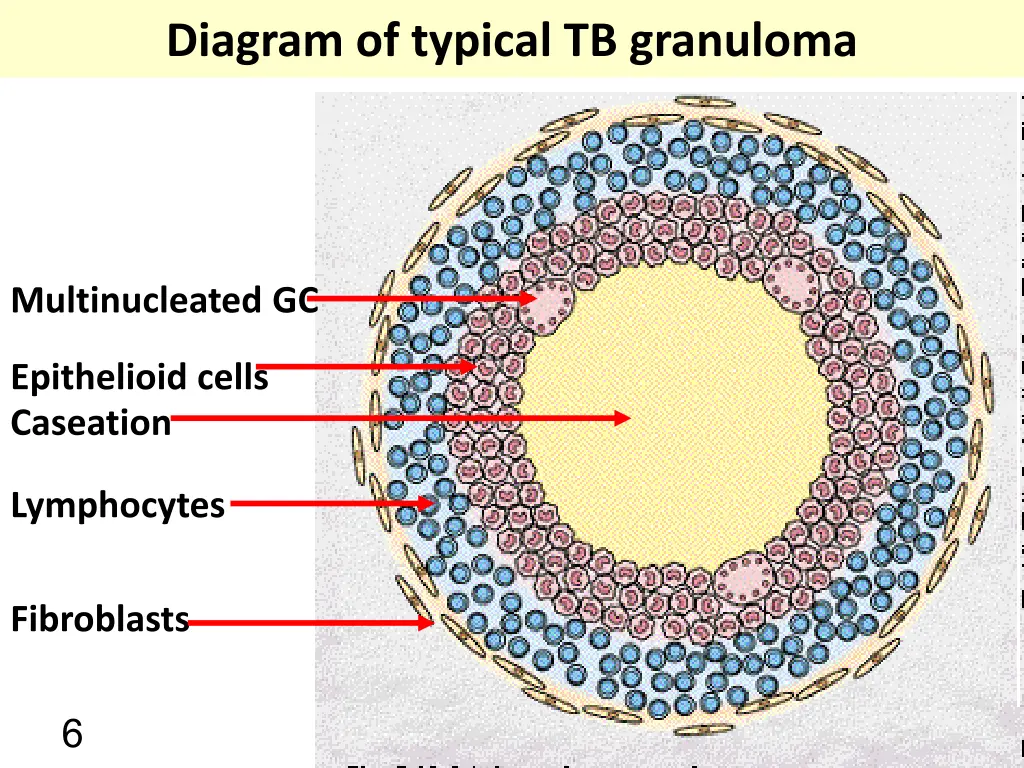diagram of typical tb granuloma