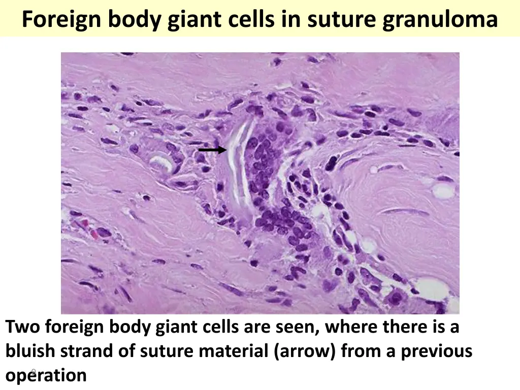 foreign body giant cells in suture granuloma