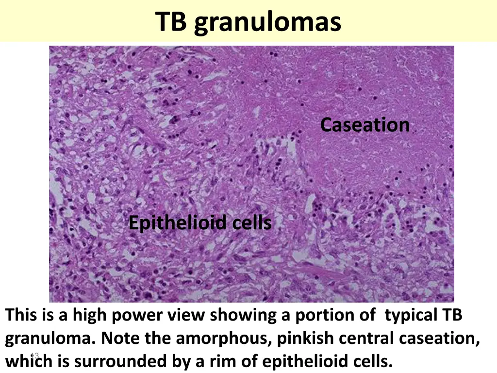 tb granulomas