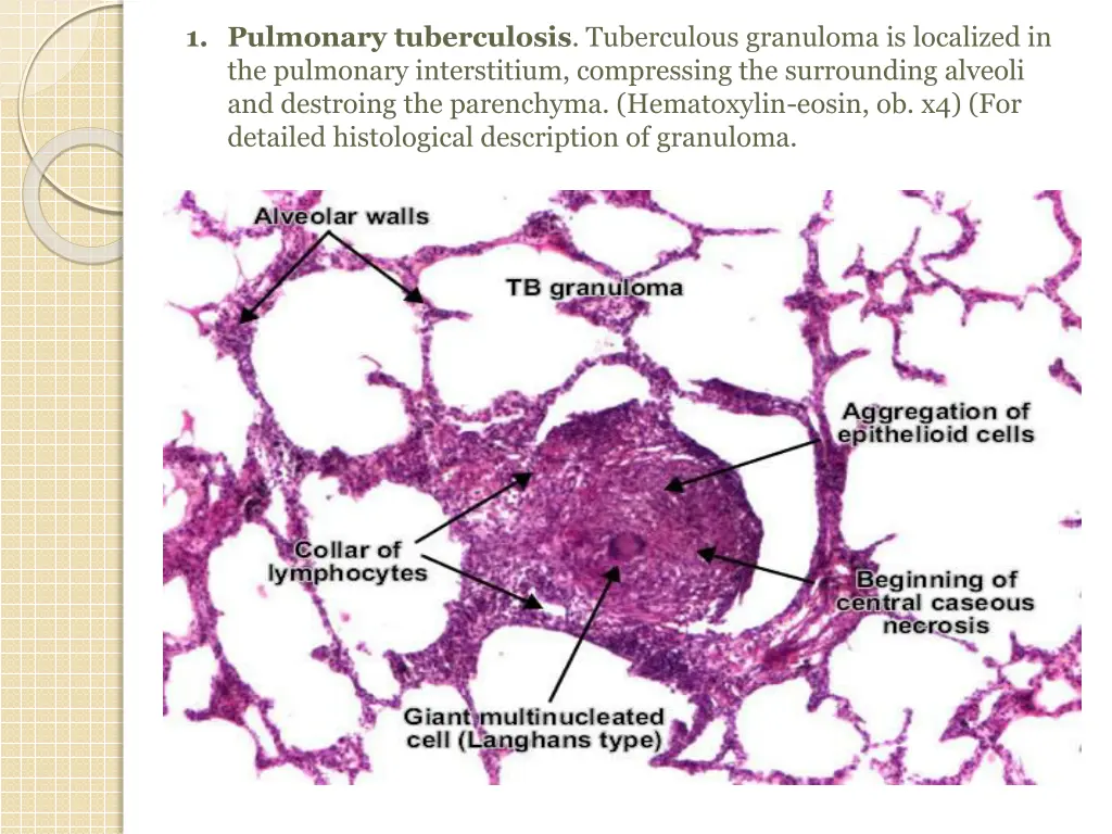 1 pulmonary tuberculosis tuberculous granuloma