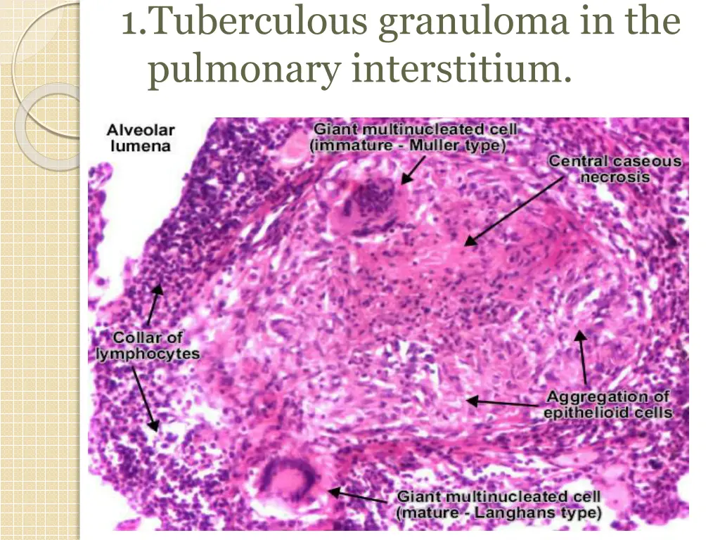 1 tuberculous granuloma in the pulmonary