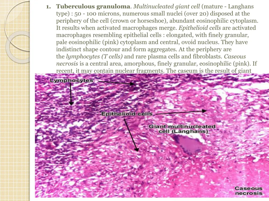 1 tuberculous granuloma multinucleated giant cell