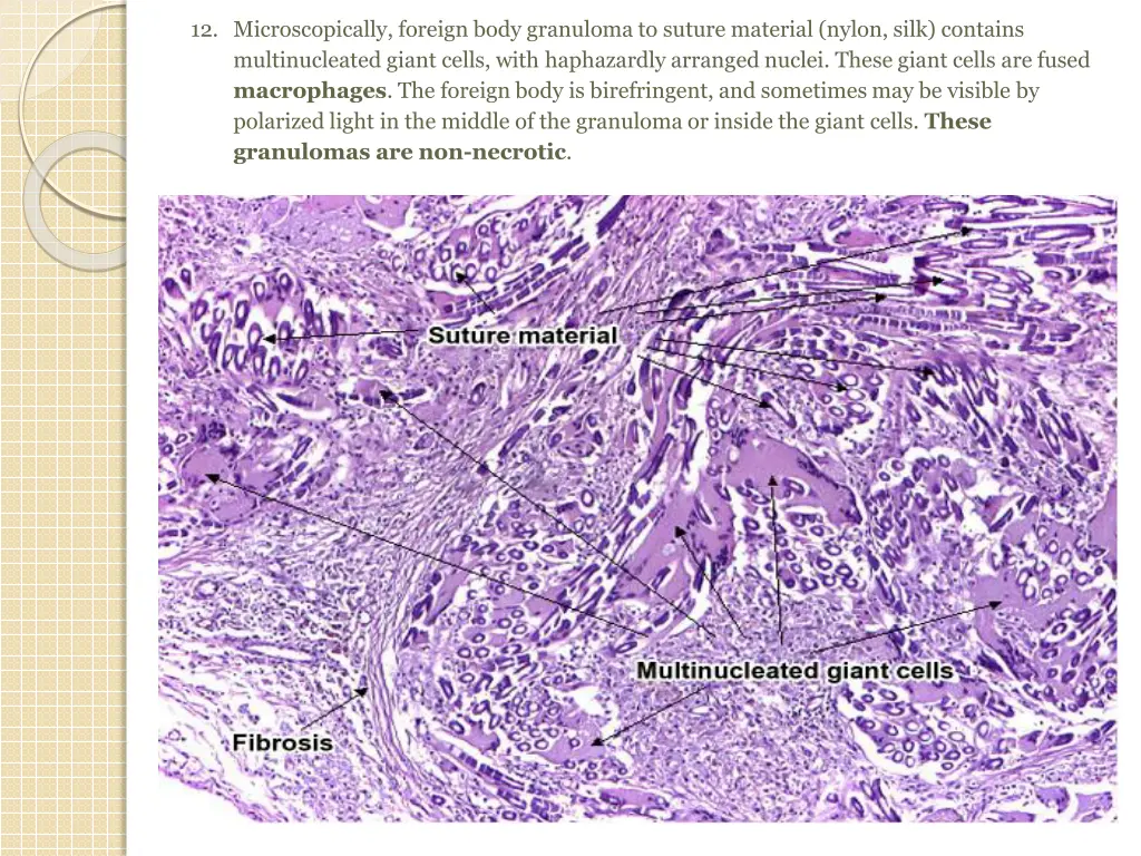 12 microscopically foreign body granuloma