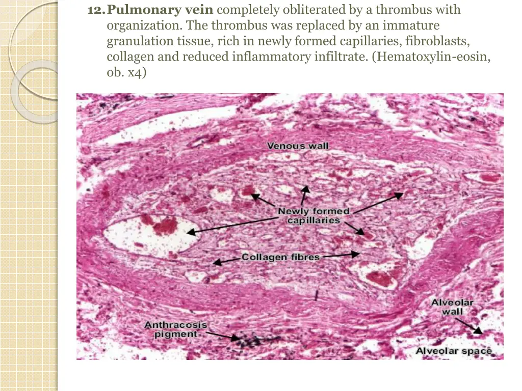 12 pulmonary vein completely obliterated