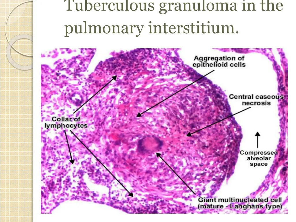 tuberculous granuloma in the pulmonary