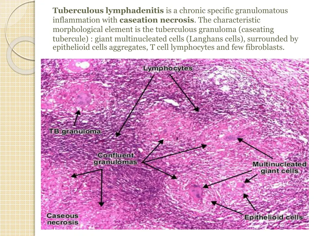 tuberculous lymphadenitis is a chronic specific