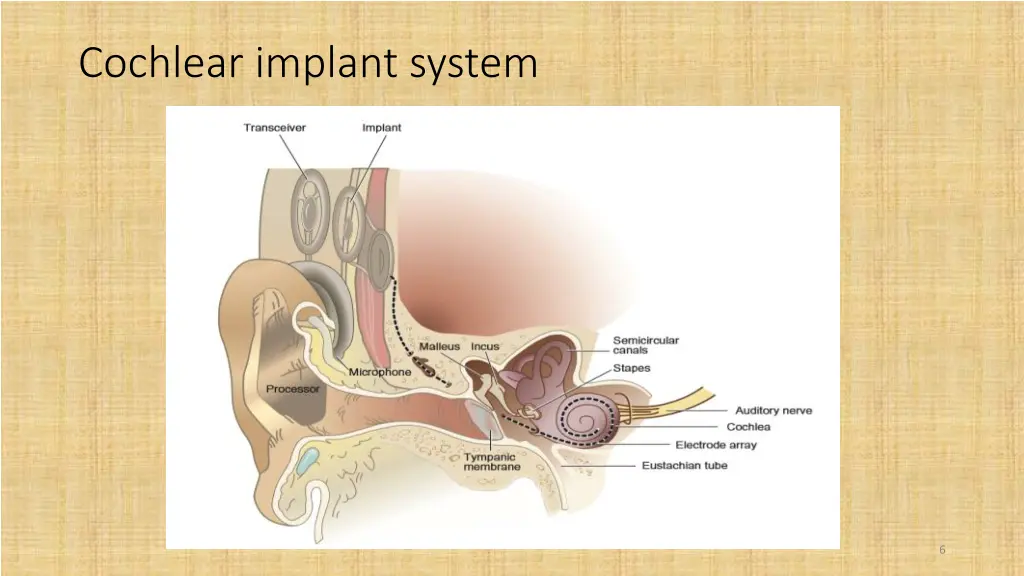 cochlear implant system