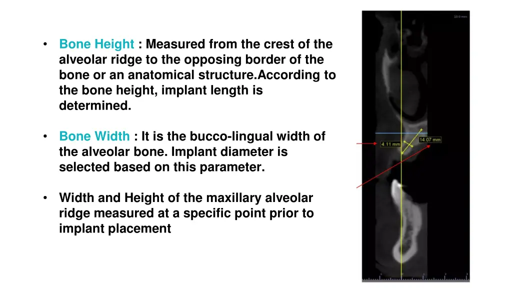 bone height measured from the crest