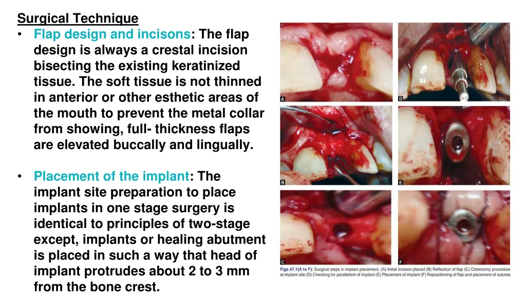 surgical technique flap design and incisons