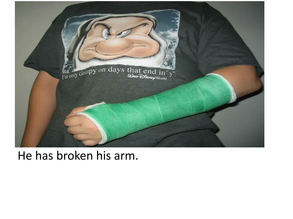 he has broken his arm