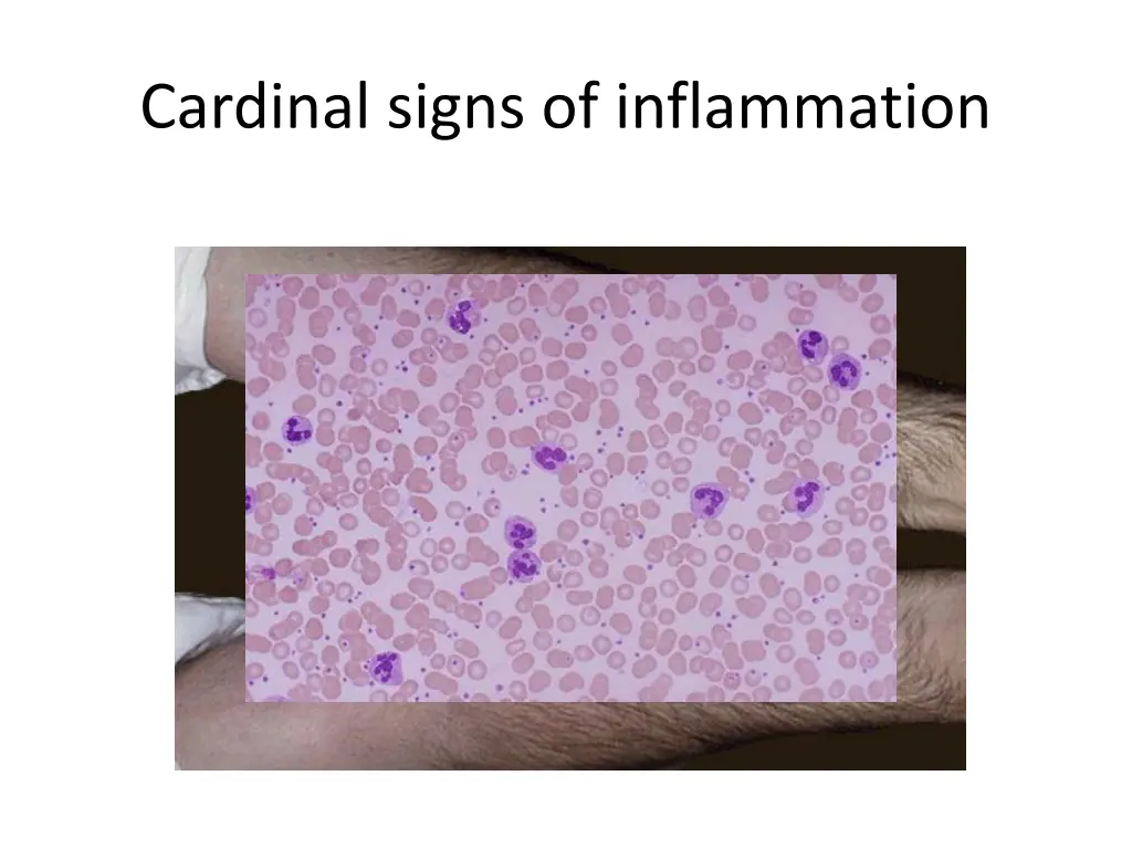 cardinal signs of inflammation 2