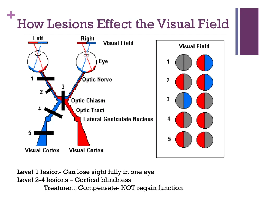 how lesions effect the visual field