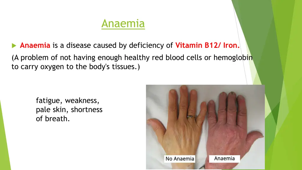 anaemia