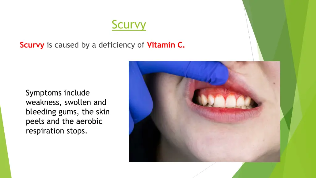 scurvy