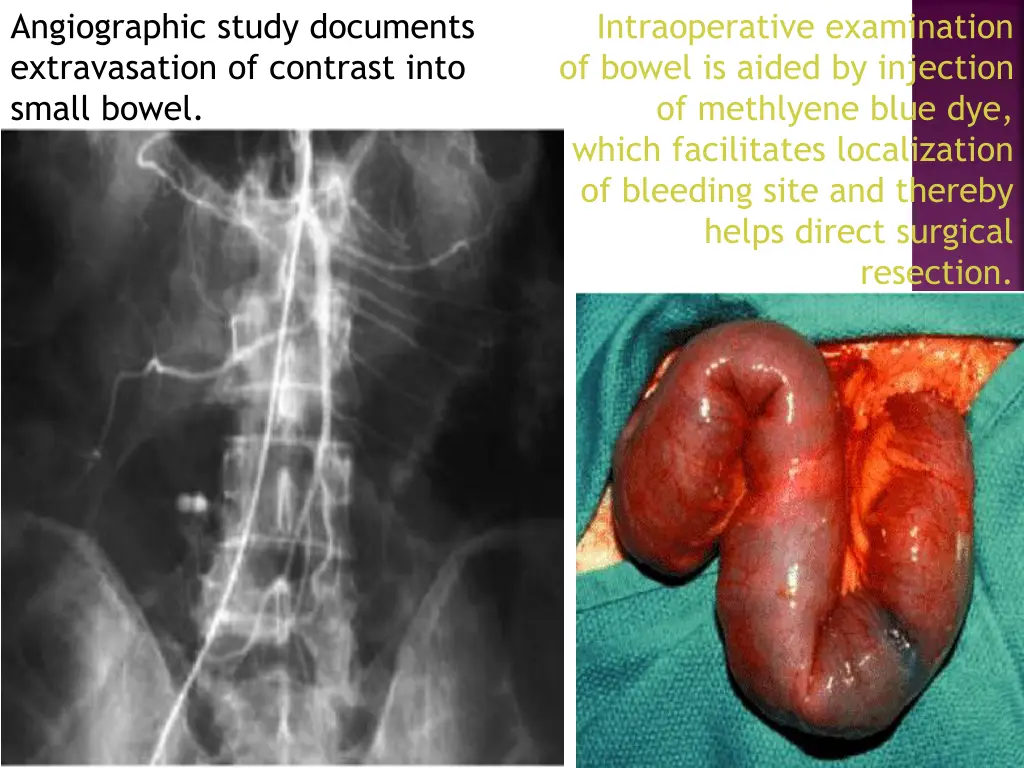 angiographic study documents extravasation