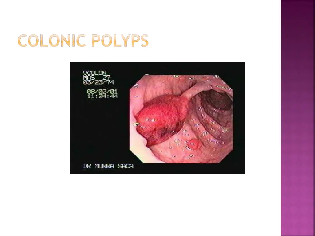 colonic polyps