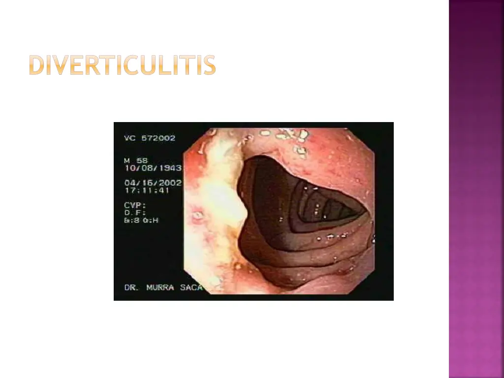 diverticulitis