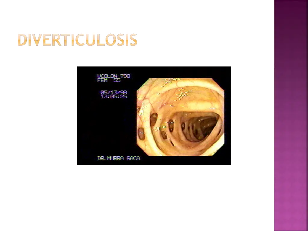 diverticulosis