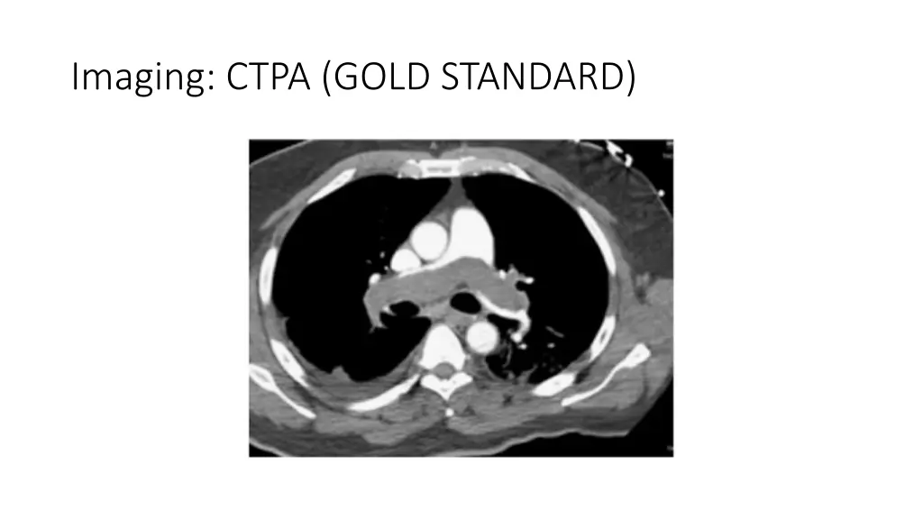 imaging ctpa gold standard