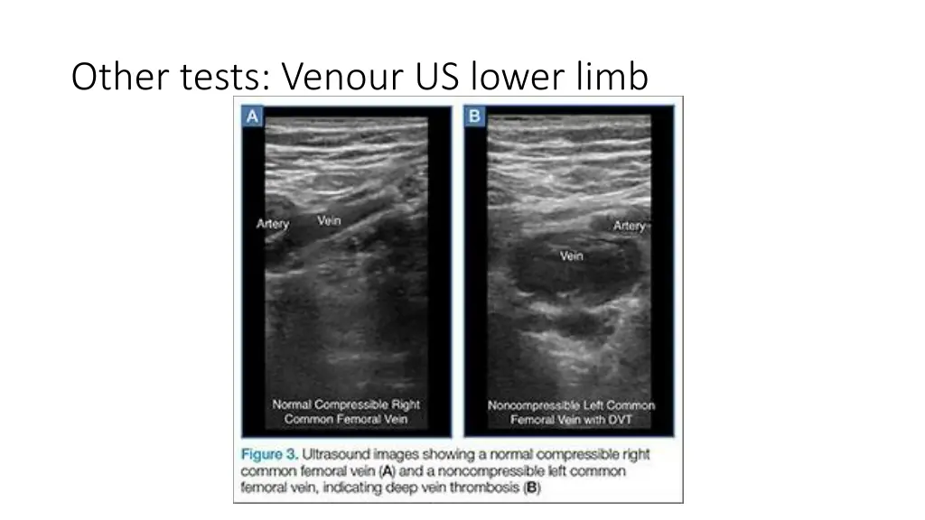 other tests venour us lower limb