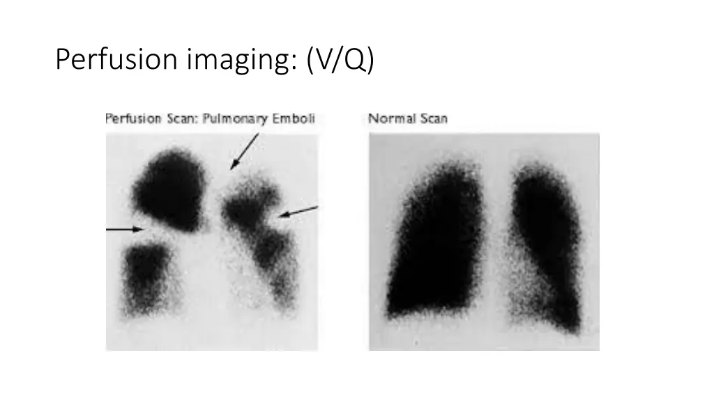 perfusion imaging v q