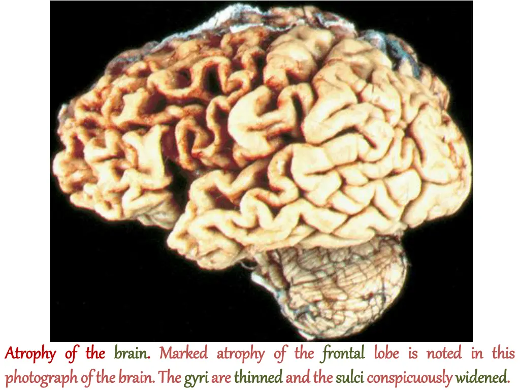 atrophy atrophy of of the photograph photograph