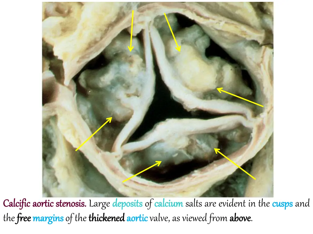 calcific calcific aortic the free free margins 1