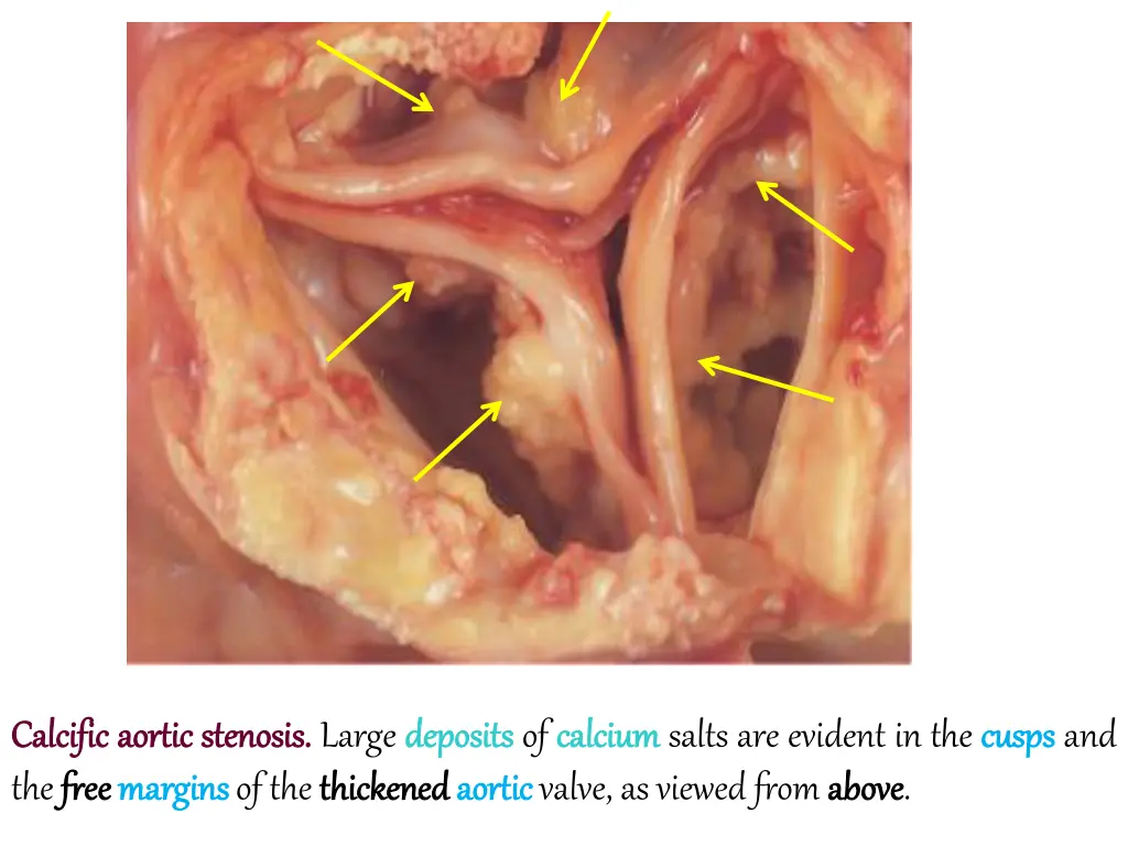 calcific calcific aortic the free free margins