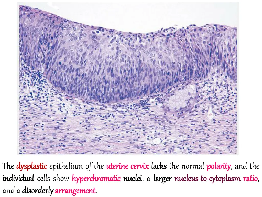 the the dysplastic dysplastic epithelium