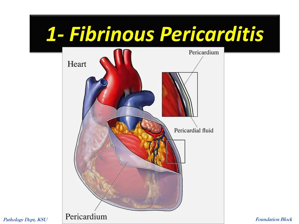 1 fibrinous pericarditis