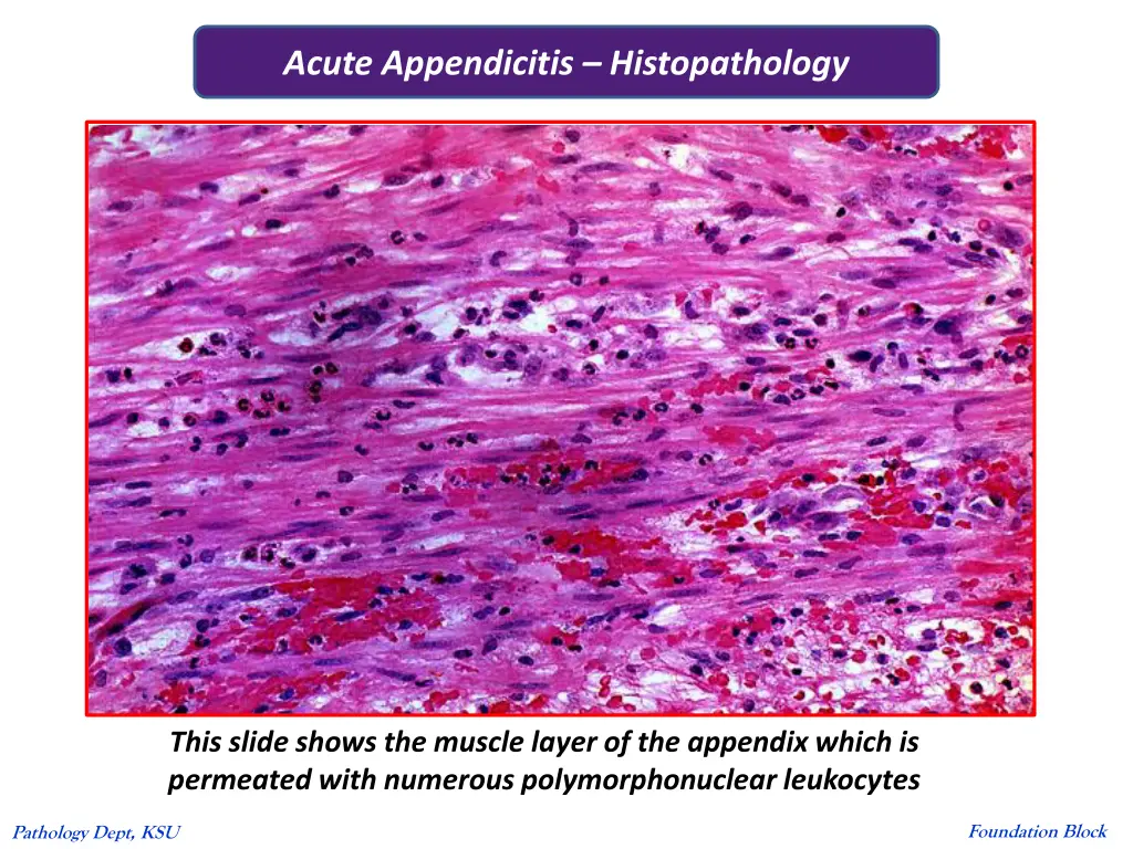 acute appendicitis histopathology