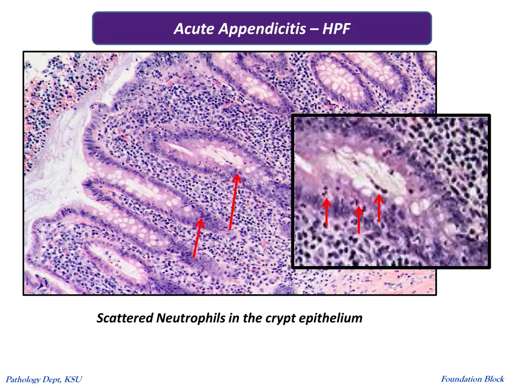 acute appendicitis hpf