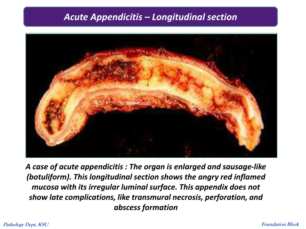 acute appendicitis longitudinal section
