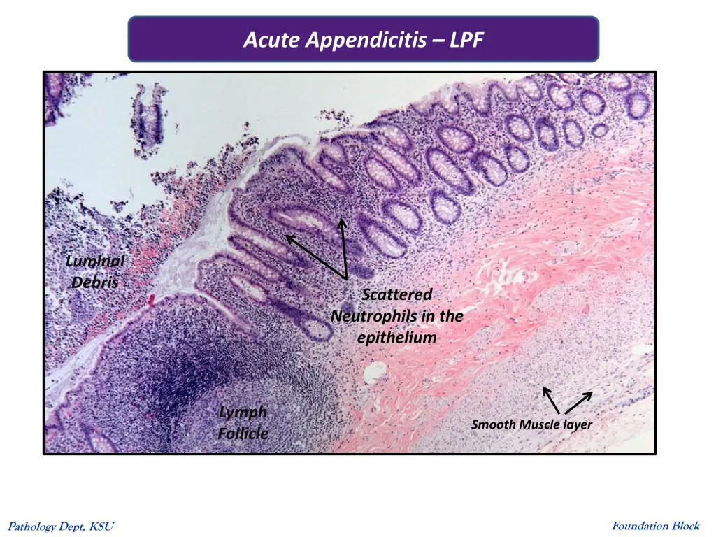 acute appendicitis lpf